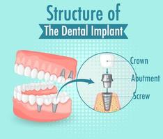 infographie de l'homme dans la structure de l'implant dentaire vecteur