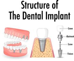 infographie de l'homme dans la structure de l'implant dentaire vecteur