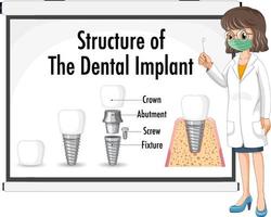 infographie de l'homme dans la structure de l'implant dentaire vecteur