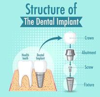 infographie de l'homme dans la structure de l'implant dentaire vecteur