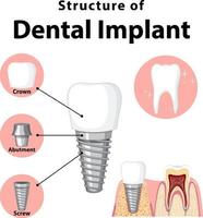 infographie de l'homme dans la structure de l'implant dentaire vecteur