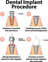 infographie de l'homme dans la structure de l'implant dentaire vecteur