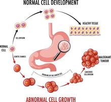 schéma montrant un cancer de l'estomac vecteur