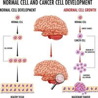 schéma montrant le cerveau humain et le cancer vecteur