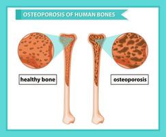 Illustration médicale scientifique de l&#39;ostéoporose des os vecteur