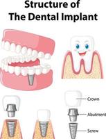 infographie de l'homme dans la structure de l'implant dentaire vecteur