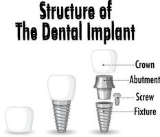 infographie de l'homme dans la structure de l'implant dentaire vecteur