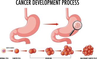 schéma montrant le processus de développement du cancer vecteur