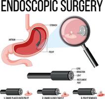 schéma montrant la chirurgie endoscopique vecteur