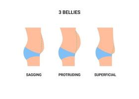 types ventres du corps humain, gros ventre avec surpoids. Ventre affaissé, saillant et superficiel. perte de poids, réduction du volume du ventre, chirurgie plastique opération. illustration vectorielle vecteur