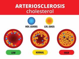 artériosclérose, cholestérol dans l'artère. vecteur