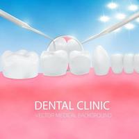diagnostic des dentistes. cavité buccale avec gomme à dents blanches et équipement dentaire vecteur