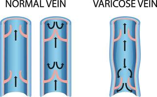 une comparaison de la veine normale avec la veine variqueuse vecteur