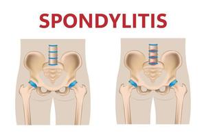 inflammation de l'articulation sacro-iliaque du bas du dos, illustration de tissu médical 3d arthrite. vecteur