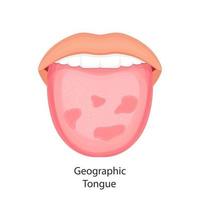 maladie de la langue, vecteur de concept d'organes.