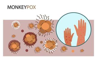 illustration vectorielle de dessin animé de concept de symptômes de monkeypox vecteur
