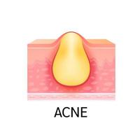 formation d'acné cutanée ou de bouton. anatomie de la peau. concept de soins de la peau de beauté médicale. sur un fond blanc. vecteur 3D.