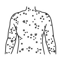éruption cutanée douloureuse sur l'icône de vecteur de dos. torse humain avec plaies, ulcères, cloques sur la peau. symptôme d'une maladie virale, bactérienne, allergique. variole, dermatite, eczéma. contour noir isolé sur blanc