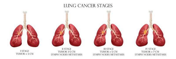 stades du cancer du poumon. concept maladies organes internes humains. style de dessin animé, illustration vectorielle. vecteur