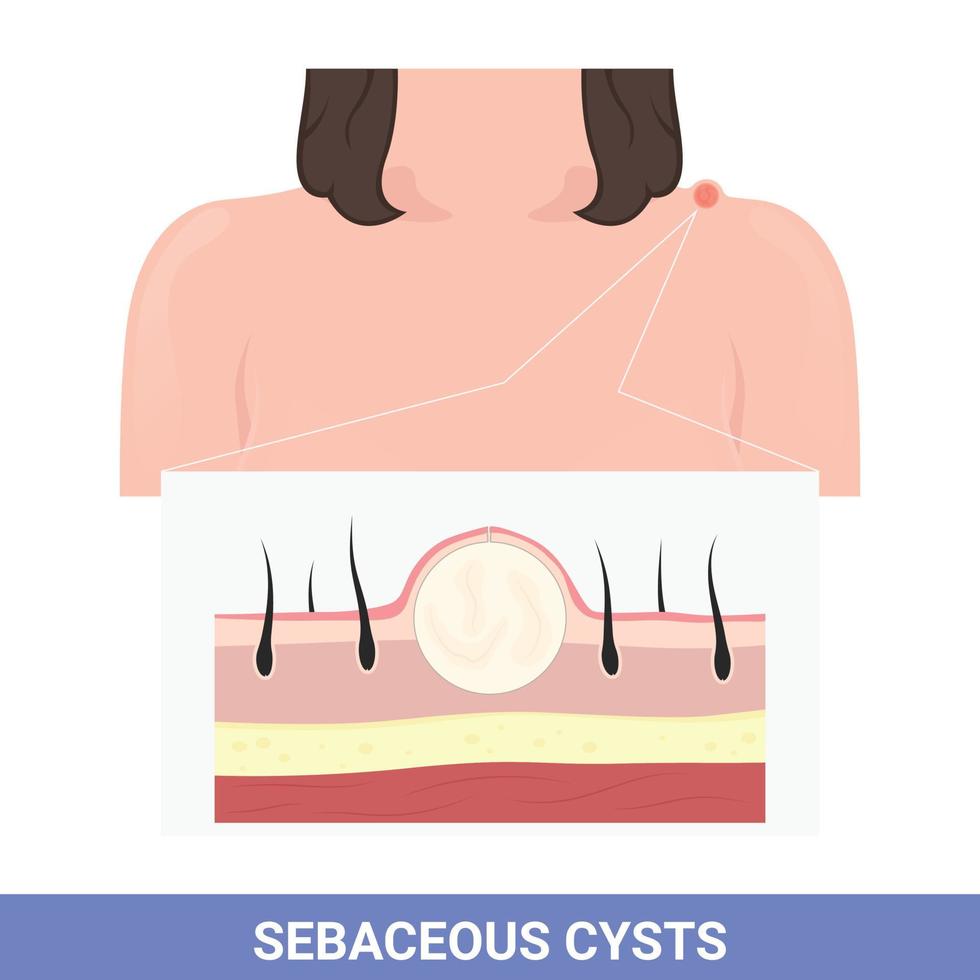 ilustração de cisto no ombro que causa inchaço e inflamação vetor