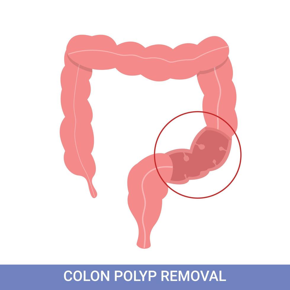 colonoscopia intestinal, procedimento de polipectomia, remoção de pólipo no cólon. cirurgia de cólon vetor