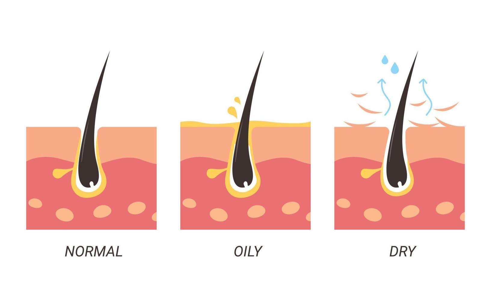 ilustração de poros normais, oleosos e secos vetor