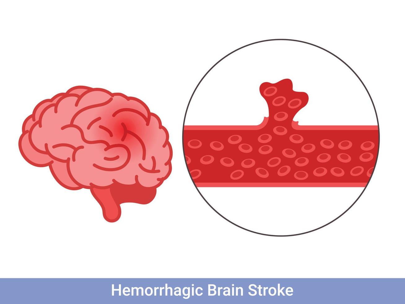 conceito de acidente vascular cerebral hemorrágico. apoplexia, hemorragia cerebral, problema de dor de cabeça vetor