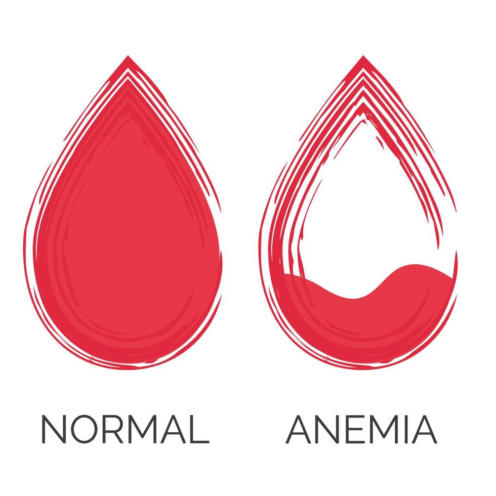gota de sangue normal e anêmica. falta de glóbulos vermelhos, anemia. isolado no fundo branco. ilustração vetorial vetor