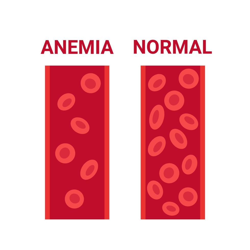 sangue normal e anemia em comparação de vasos, número de células de circulação eritrócitos. hemoglobina baixa, anemia ferropriva. células sanguíneas anêmicas da doença. problema de saúde. ilustração vetorial vetor