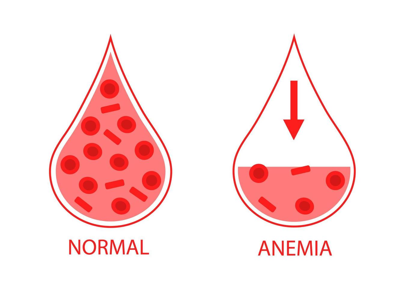 comparando duas gotas de sangue de células sanguíneas normais e anêmicas. hemoglobina baixa. imagem isolada no fundo branco. vetor