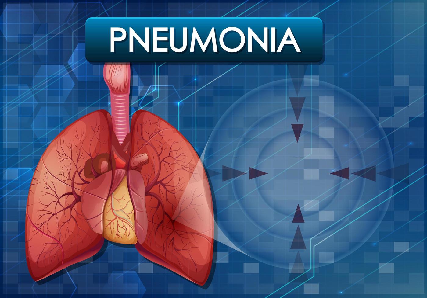 pneumonia que adoece o pulmão humano vetor