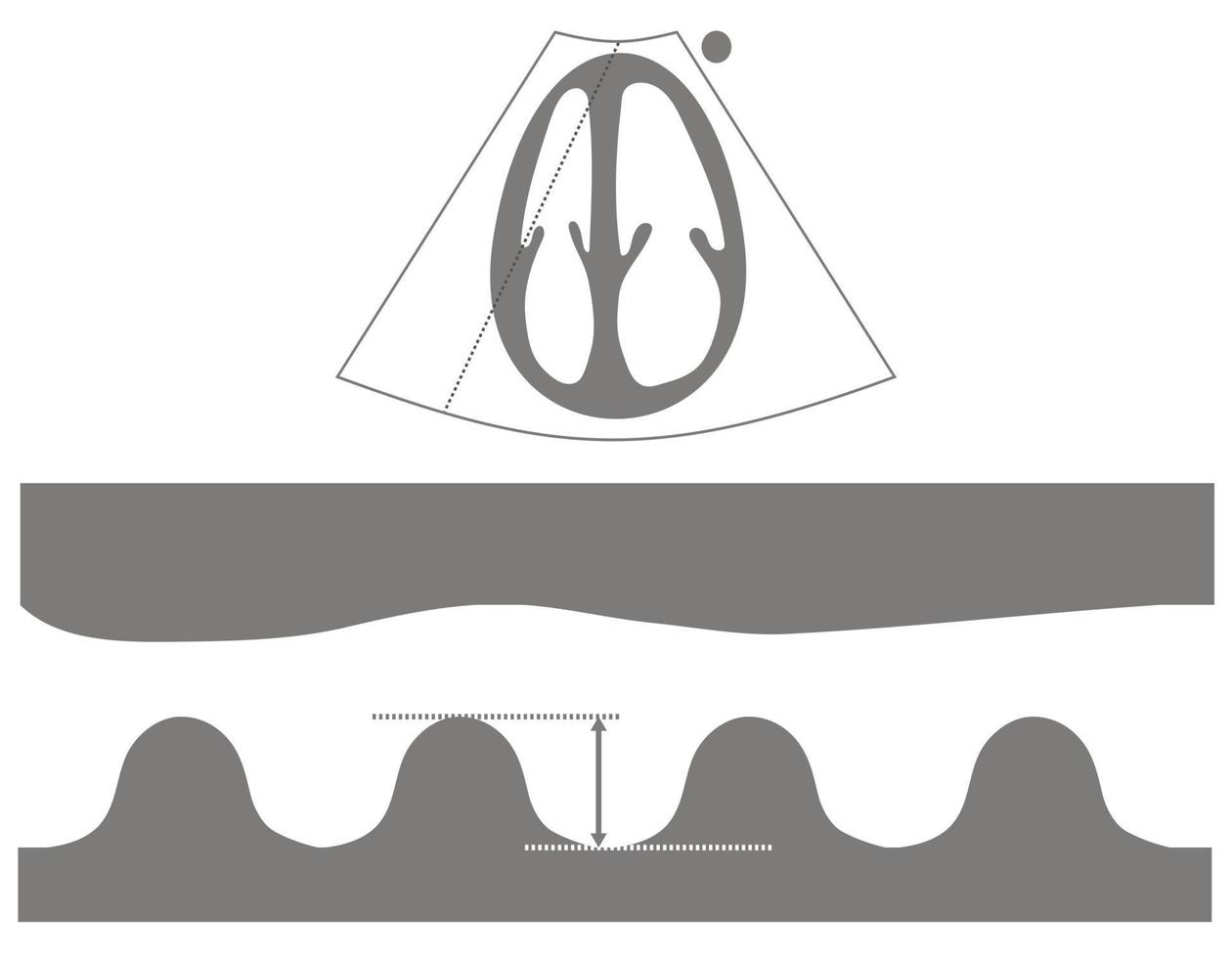 diagrama de medida da excursão sistólica do plano do anel tricúspide ou tapse do ecocardiograma vetor