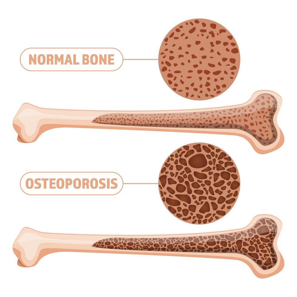 anatomia da osteoporose isolada vetor