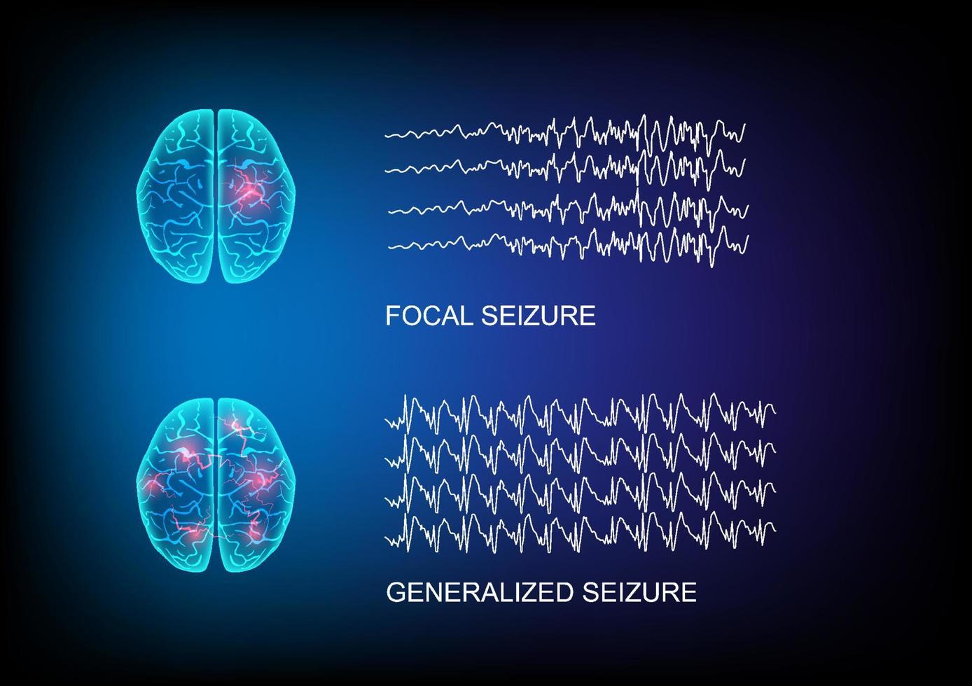 ilustração de tipos de convulsões demonstrando por início e ondas cerebrais em fundo de tecnologia. vetor