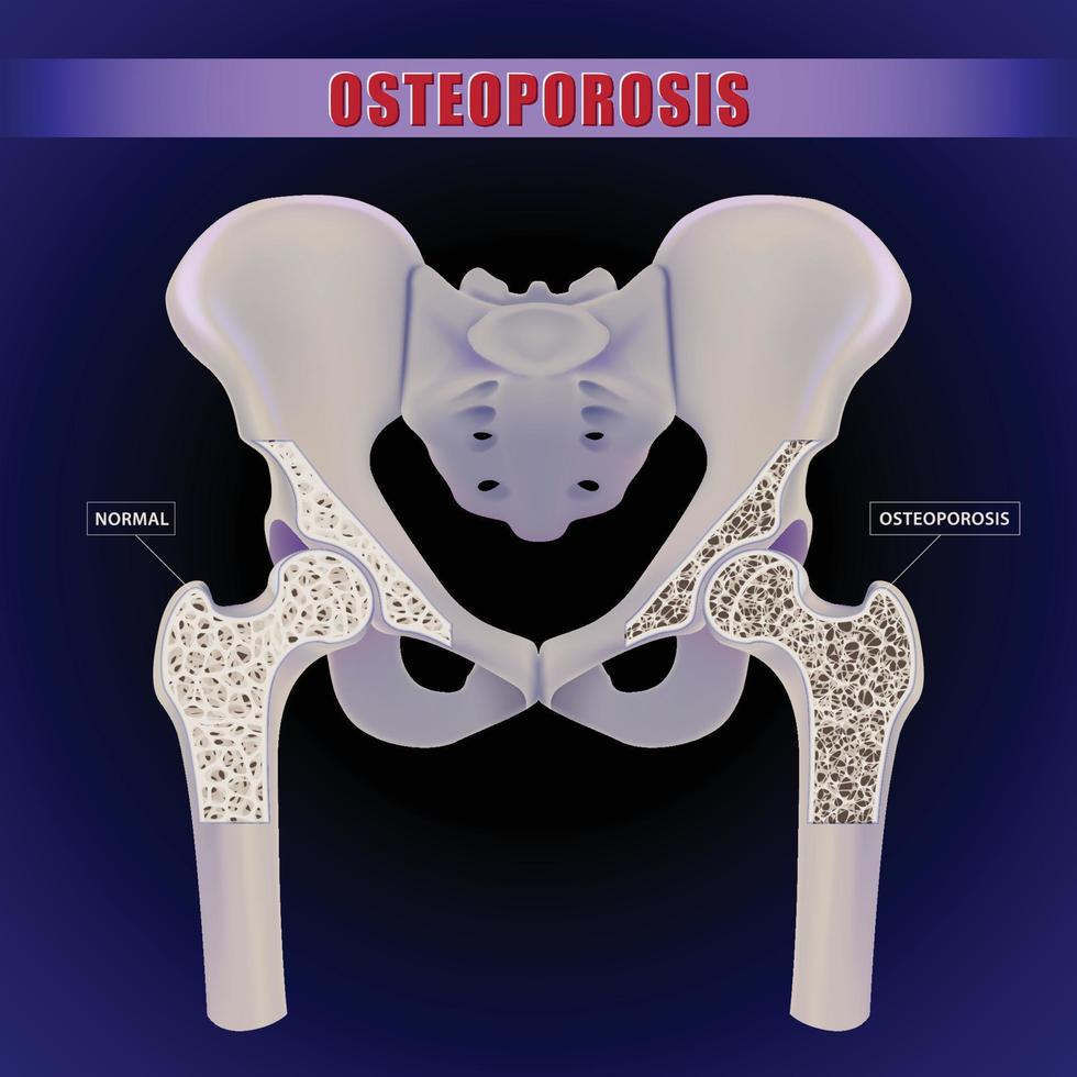 Ilustração 3D de um osso do quadril humano comparando o interior dos sintomas ósseos normais com a osteoporose. vetor