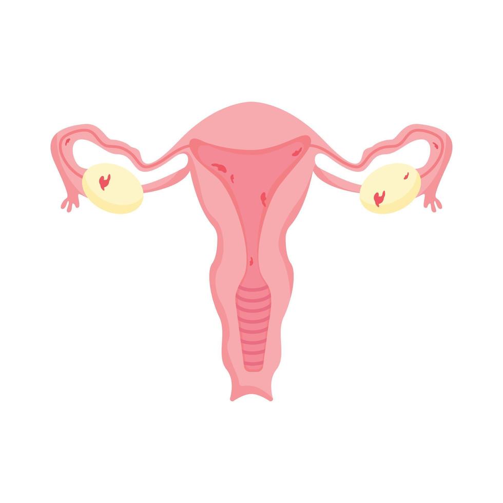genitais femininos. endometriose, ilustração vetorial vetor