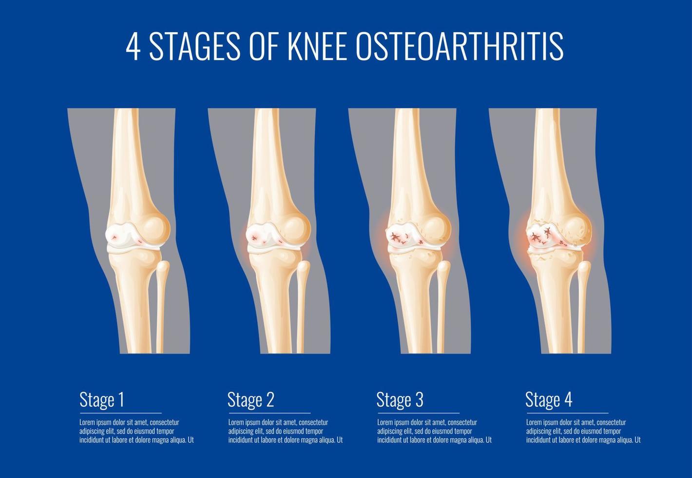 estágios da osteoartrite da articulação do joelho, infográficos vetor