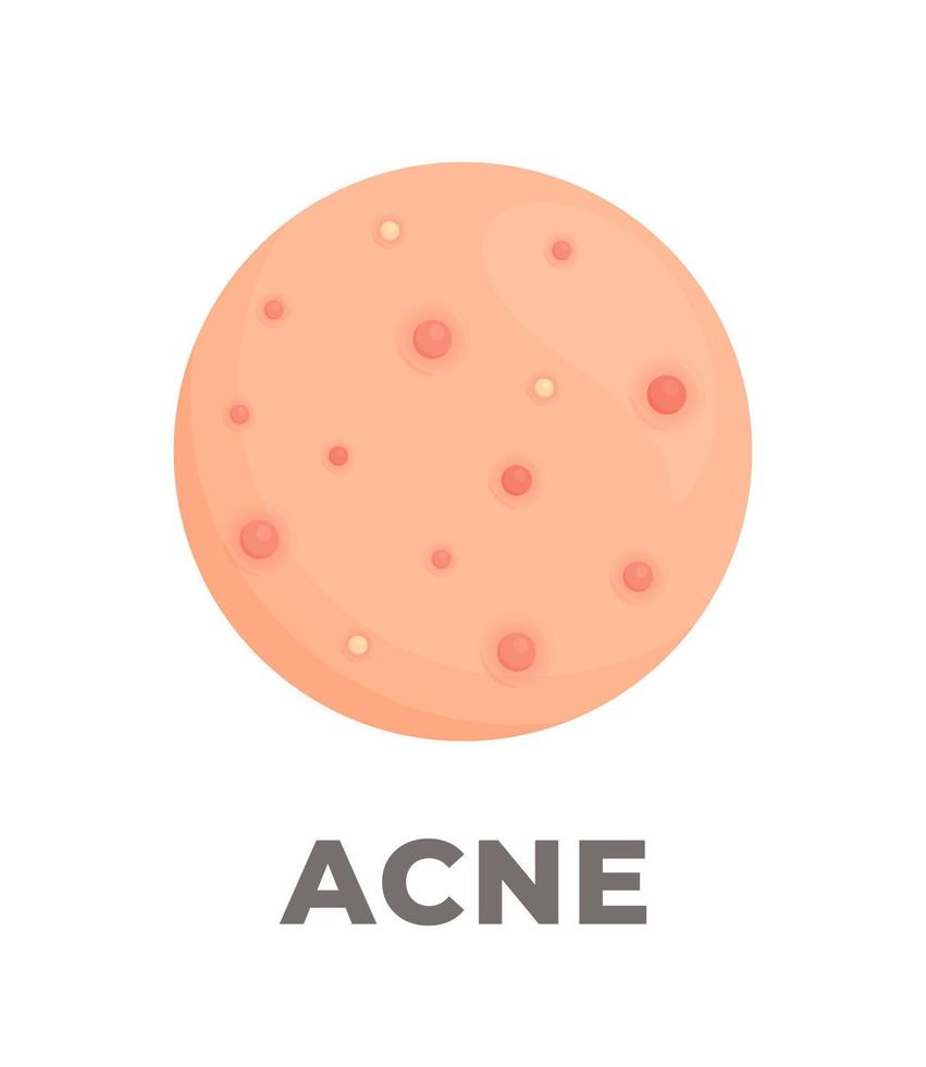 as consequências de um cuidado deficiente da pele. ilustração em vetor de espinhas inflamadas na pele. acne. doença dermatológica.