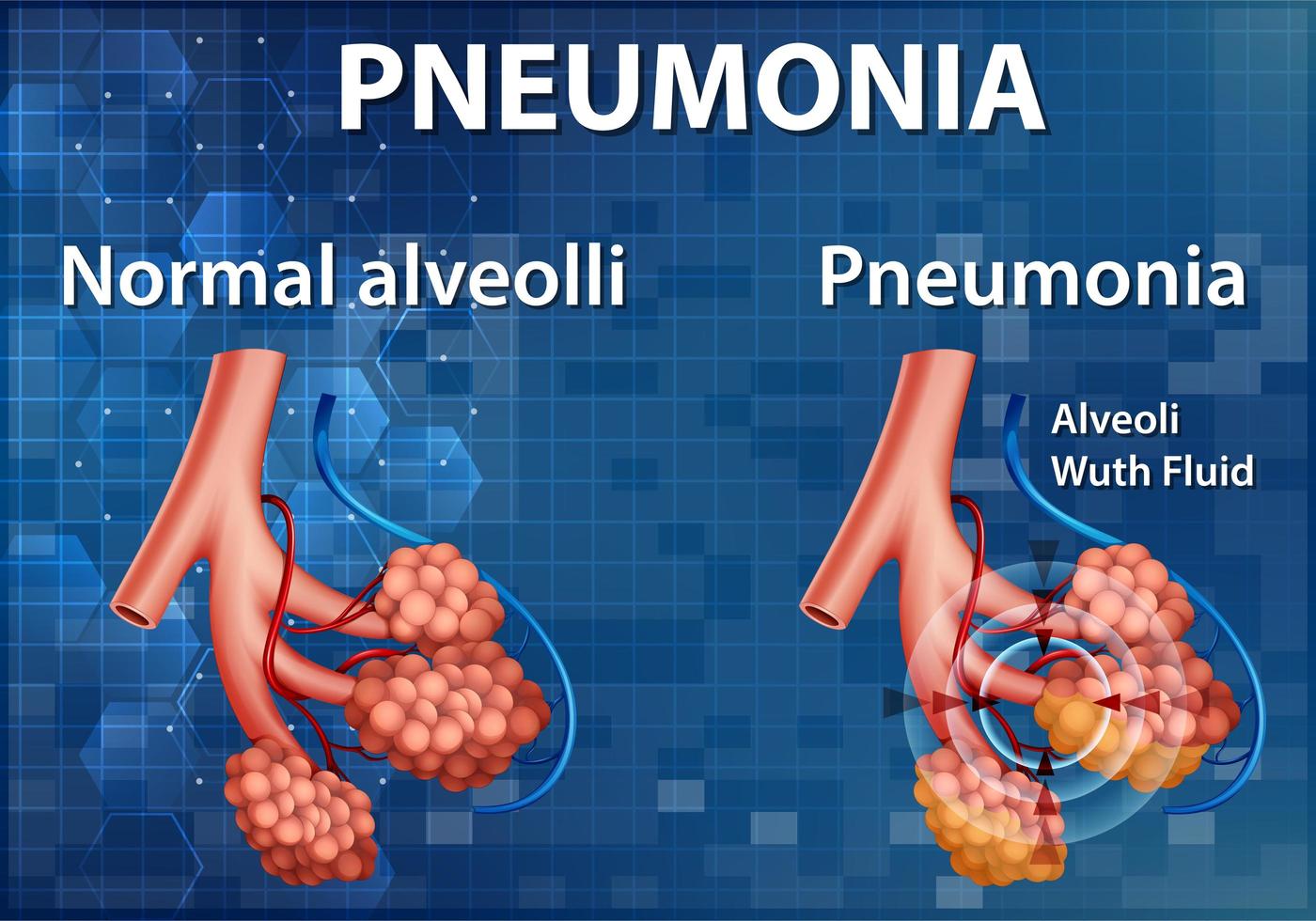 comparação de alvéolos saudáveis e pneumonia vetor