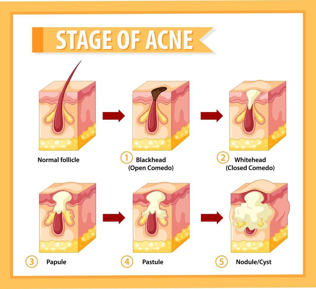 estágios da anatomia da acne da pele vetor