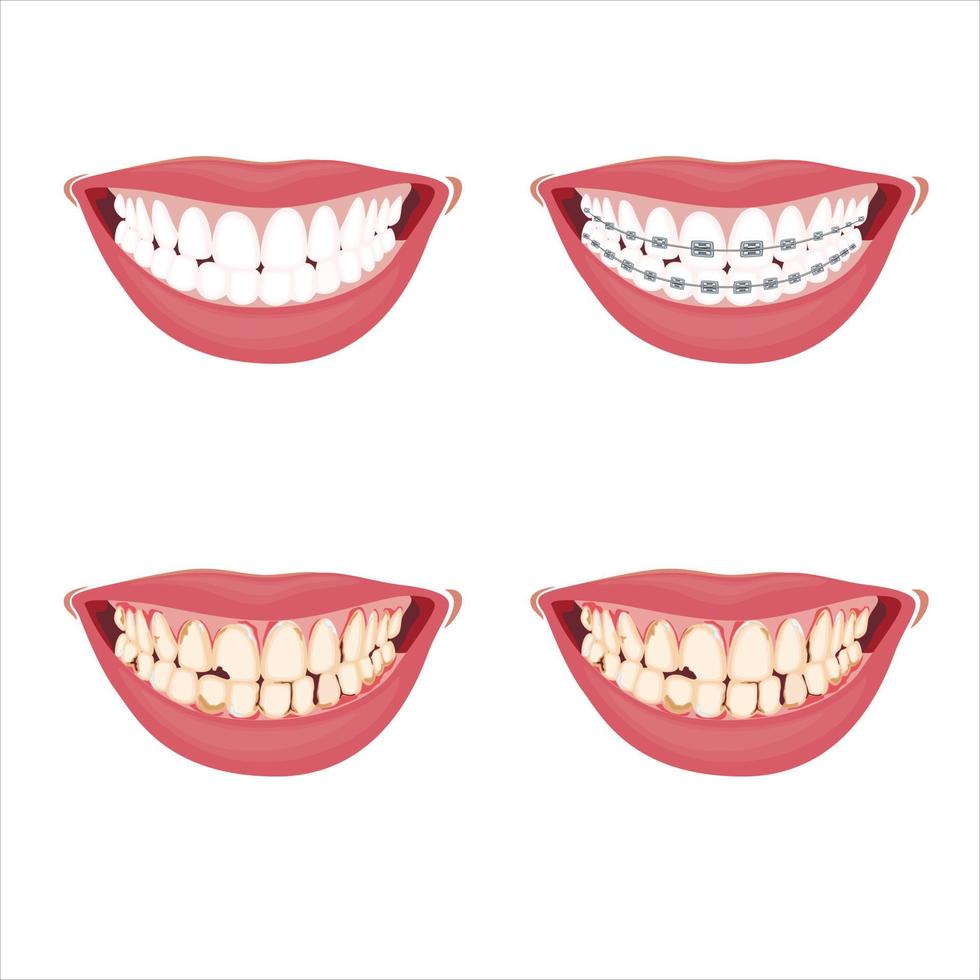 ilustração de dente saudável e danificado, aparelho dentário, dentes danificados, ilustração vetorial de dentista, cuidados bucais vetor