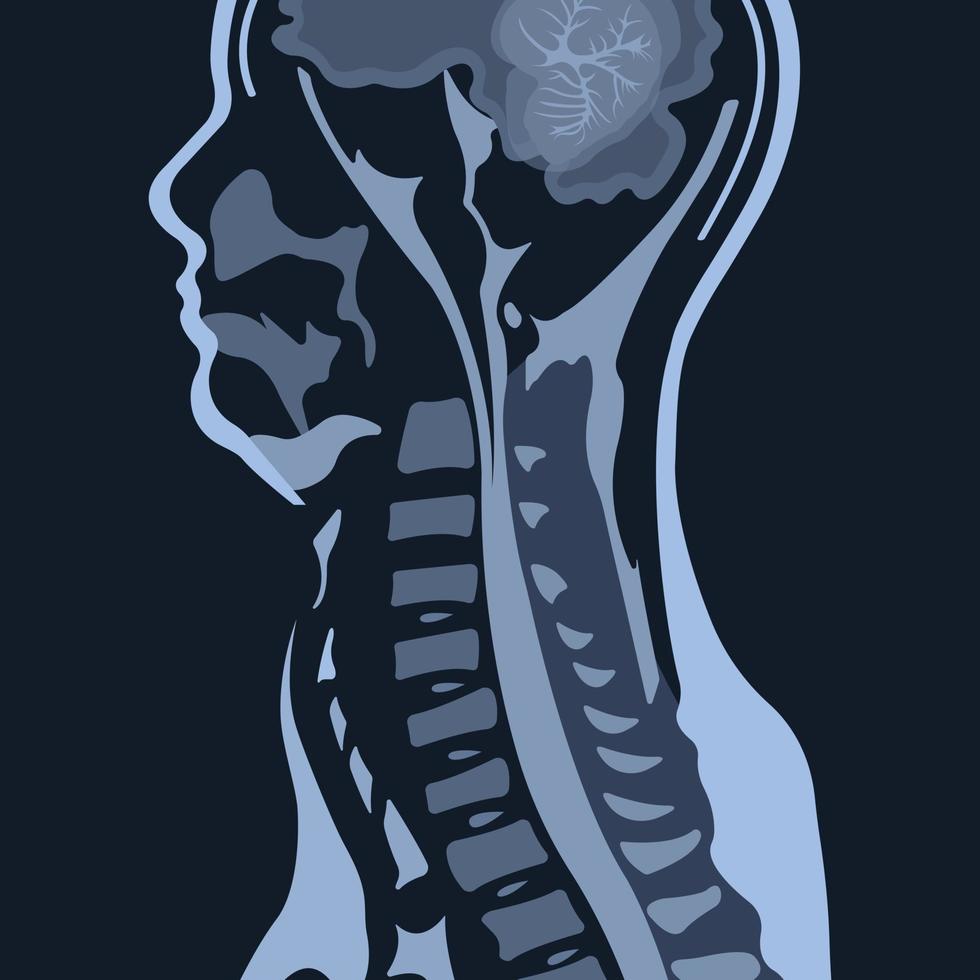 imagem de ressonância magnética ou ressonância magnética da coluna cervical em projeção sagital demonstrando espondilose cervical e compressão da medula espinhal. a doença causa dor no pescoço e radiculopatia. vetor