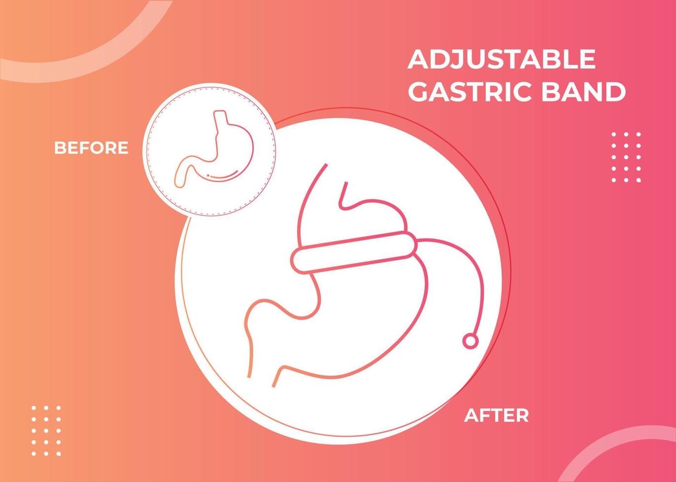 ilustração de vetor de cirurgia para perda de peso com dispositivo de banda gástrica ajustável