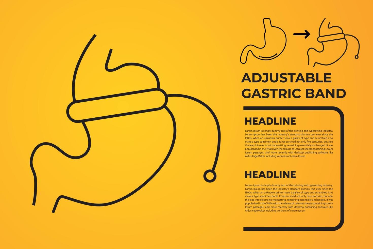 ilustração de vetor de cirurgia para perda de peso com dispositivo de banda gástrica ajustável