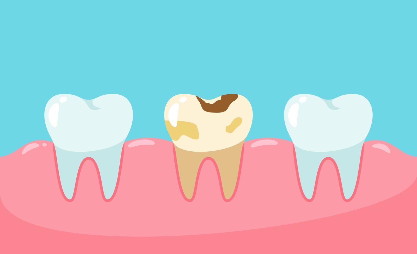 vetor dentes insalubres. cáries e placa dentária