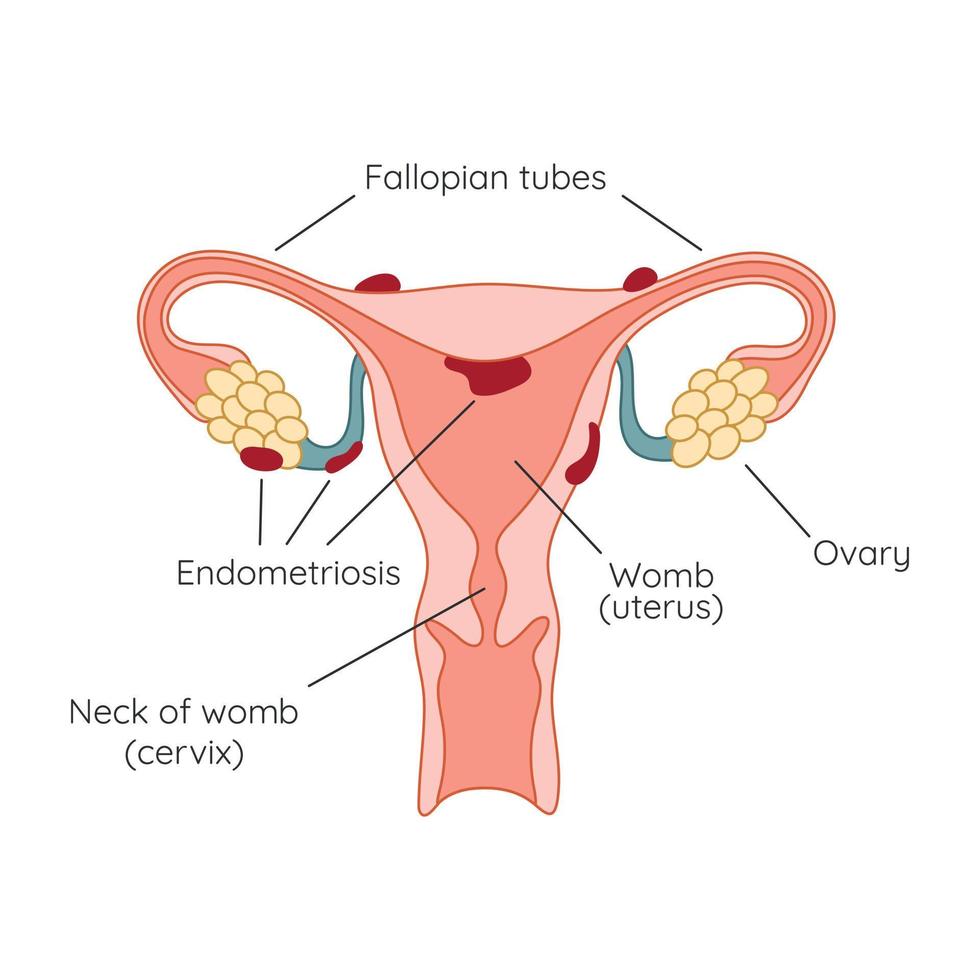 endometriose. o aparecimento da doença endometriose. endométrio. infográfico vetor