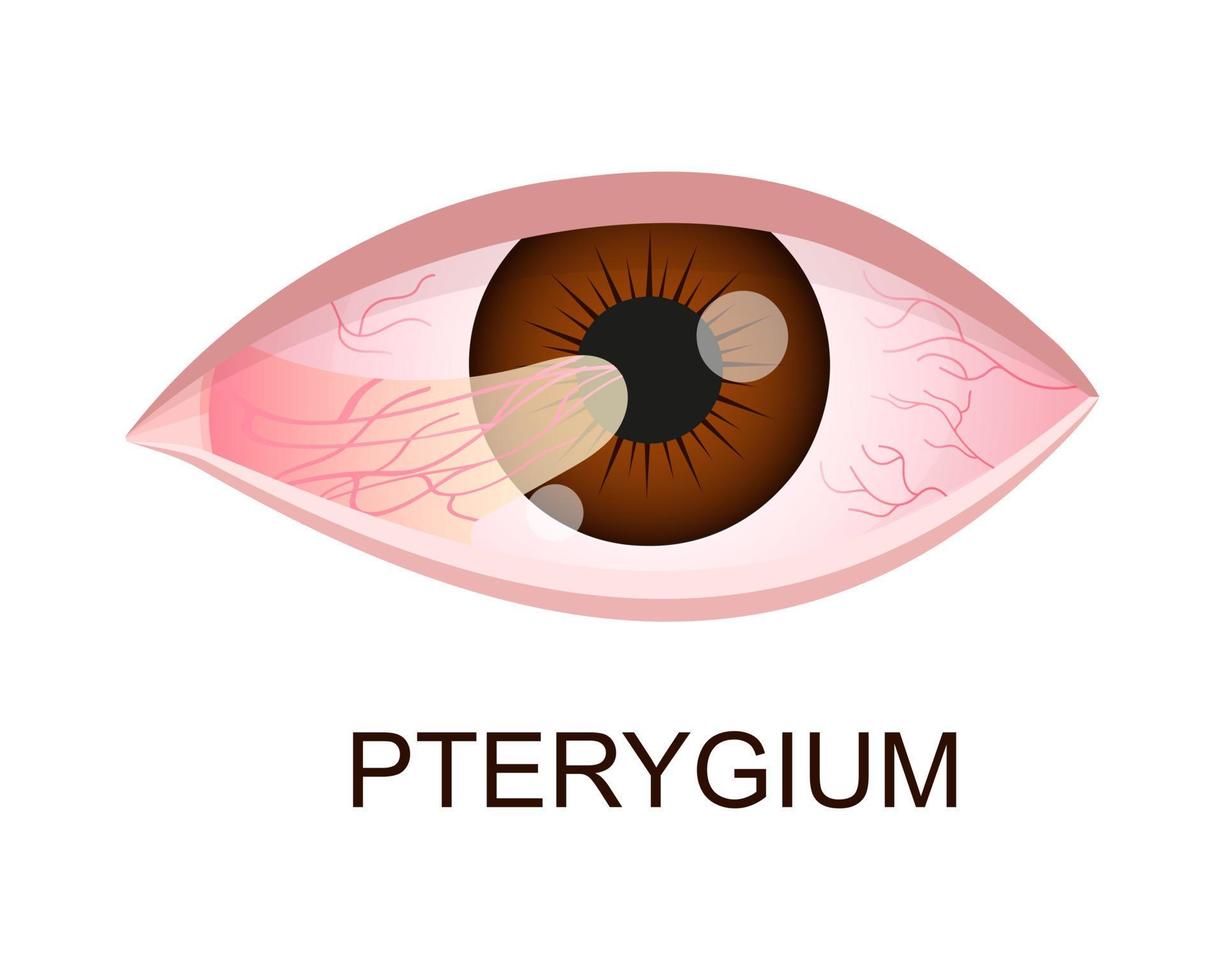 pterígio crescendo na córnea. degeneração conjuntival. doença ocular. órgão humano da visão com patologia vetor