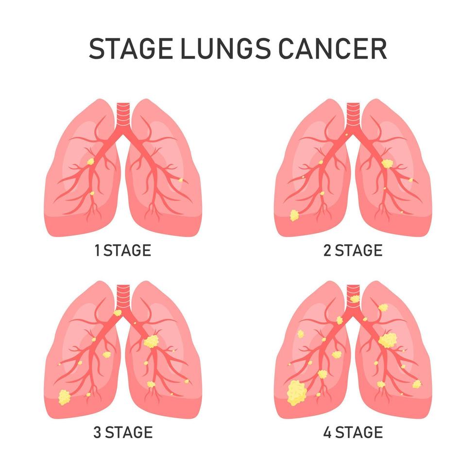 conceito de vetor de câncer de pulmão. ilustração vetorial.