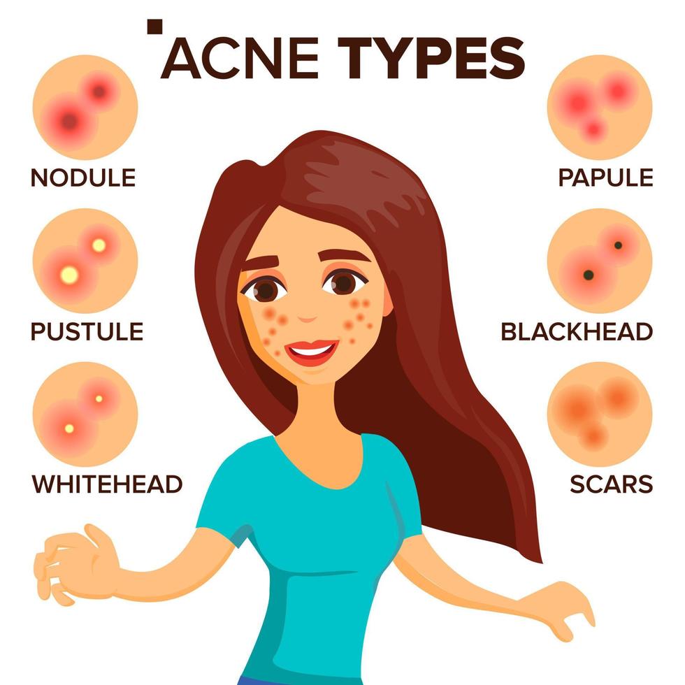 vetor de tipos de acne. menina com acne. cuidados com a pele. tratamento, saudável. nódulo, whitehead. ilustração de personagem de desenho animado plana isolada