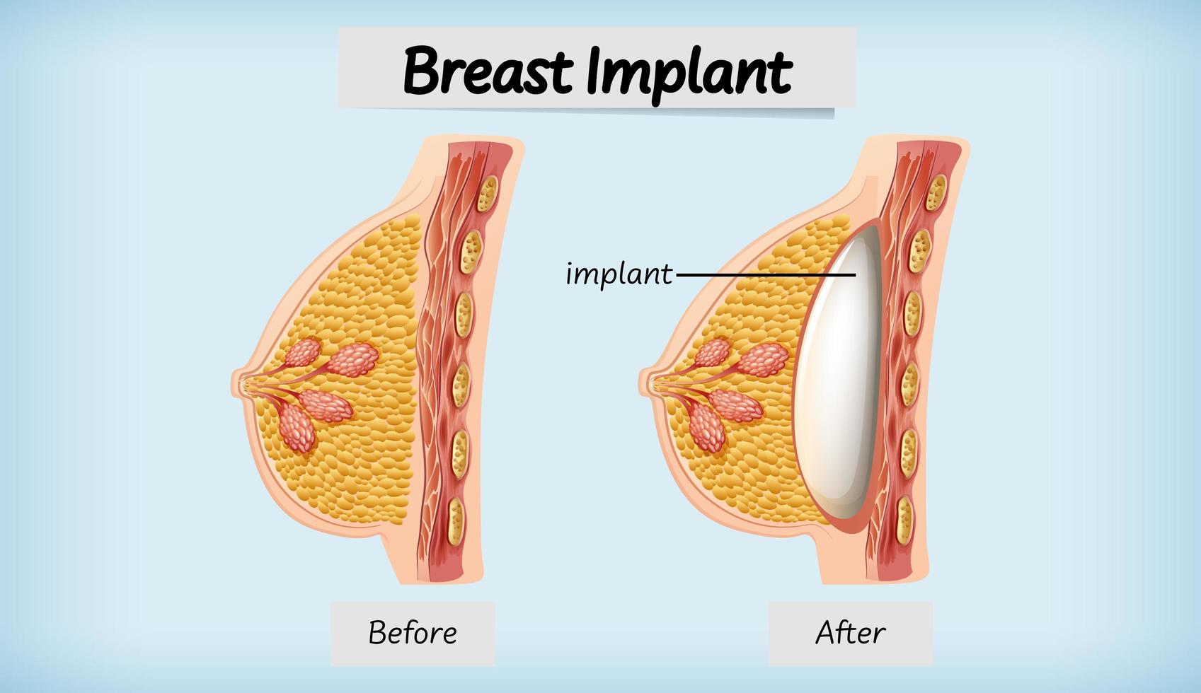 anatomia do implante mamário humano vetor